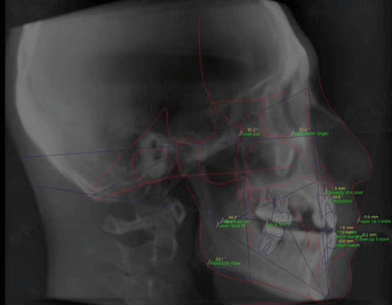 Cephalometric Landmark Analysis