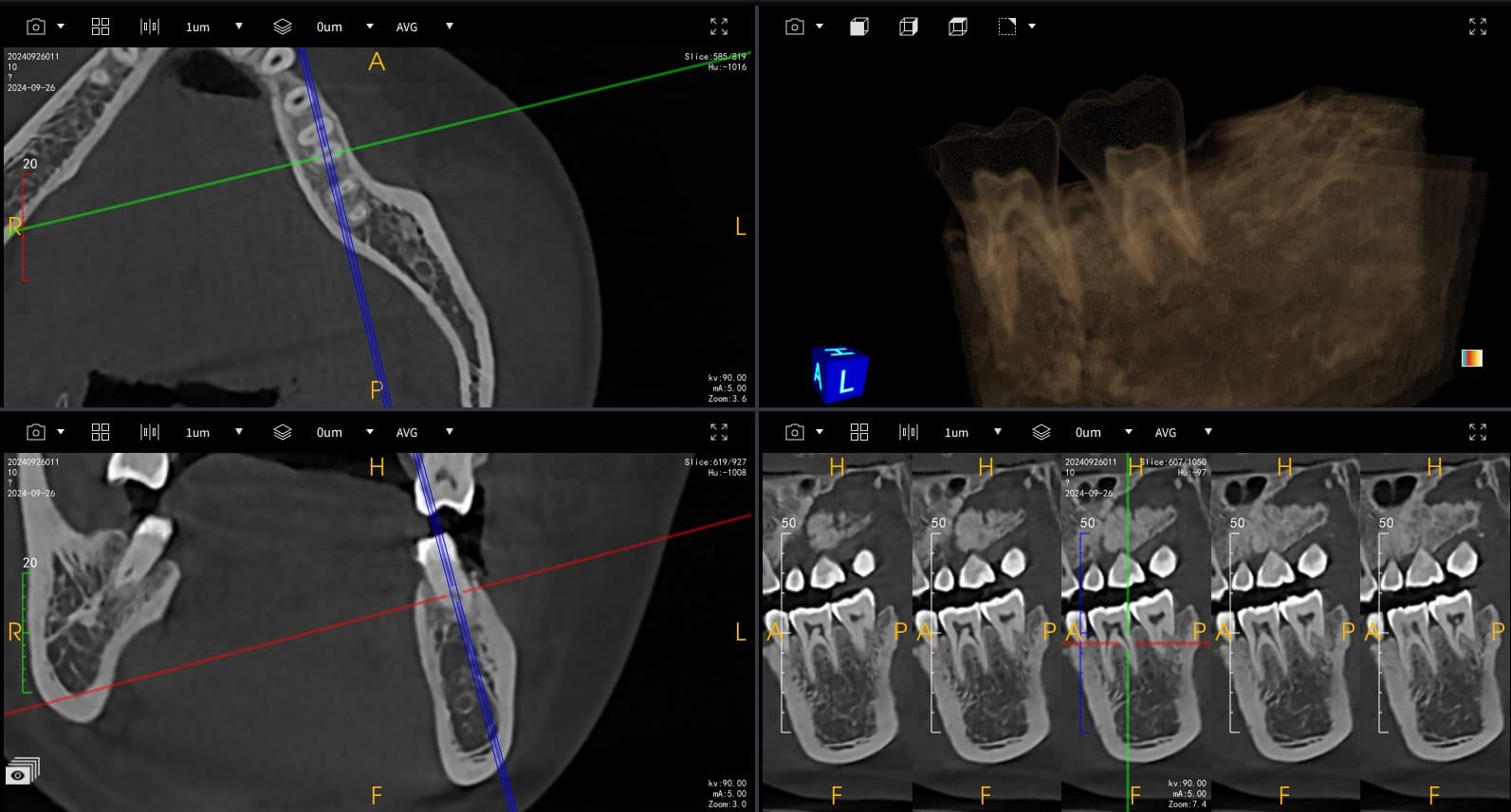 Implant Cross-Section Detail