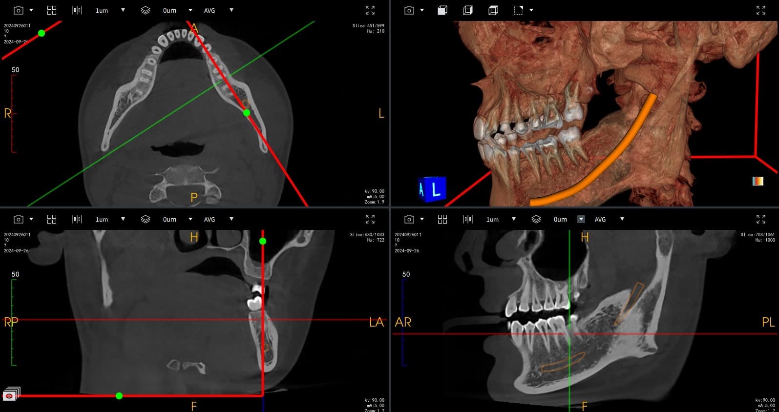 Nerve Canal Tracing with 3D Rendering
