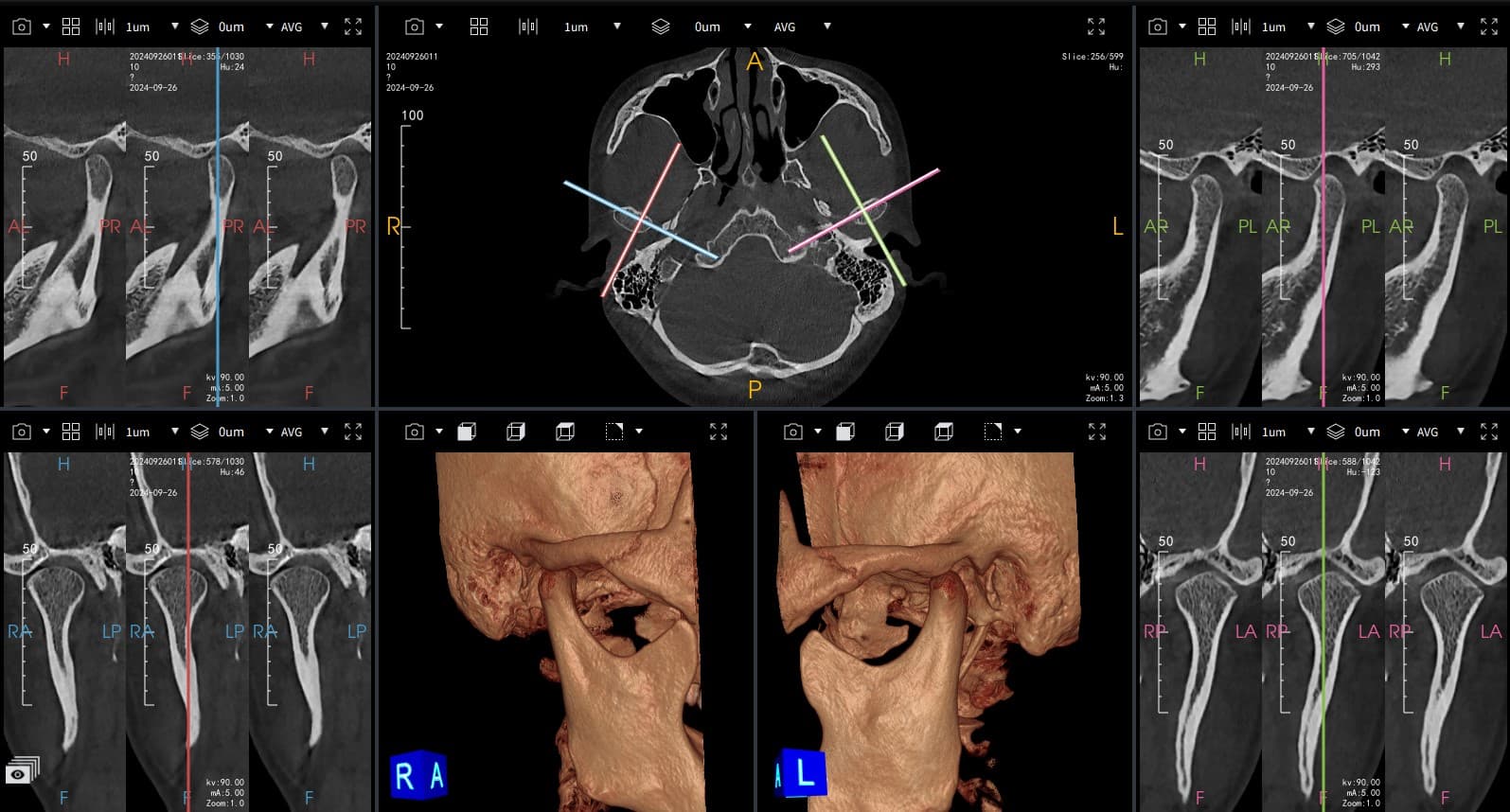 TMJ Bilateral Analysis
